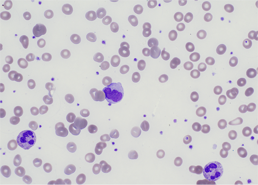 CYTOLOGIE:ERYTHROBLASTOPENIE